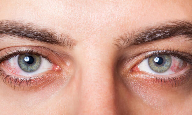 Derrame Ocular: O Que é, Sintomas e Quando Buscar Ajuda Médica