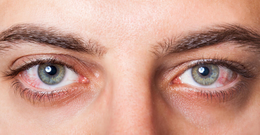 Derrame Ocular: O Que é, Sintomas e Quando Buscar Ajuda Médica
